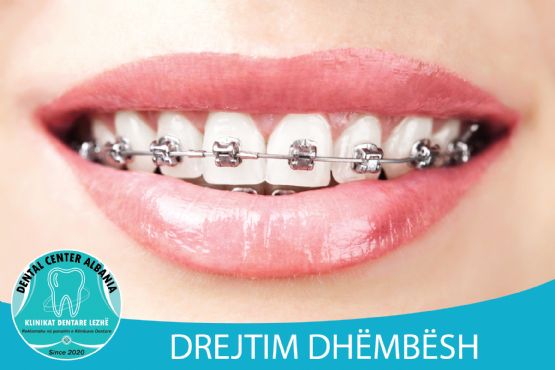 Drejtim dhëmbësh pa tela ose transparent nga DENTAL CENTER LEZHA